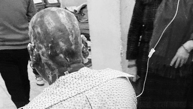 बागलुङमा एक पुरुषले पेट्रोल छर्केर आत्मदाहको प्रयास